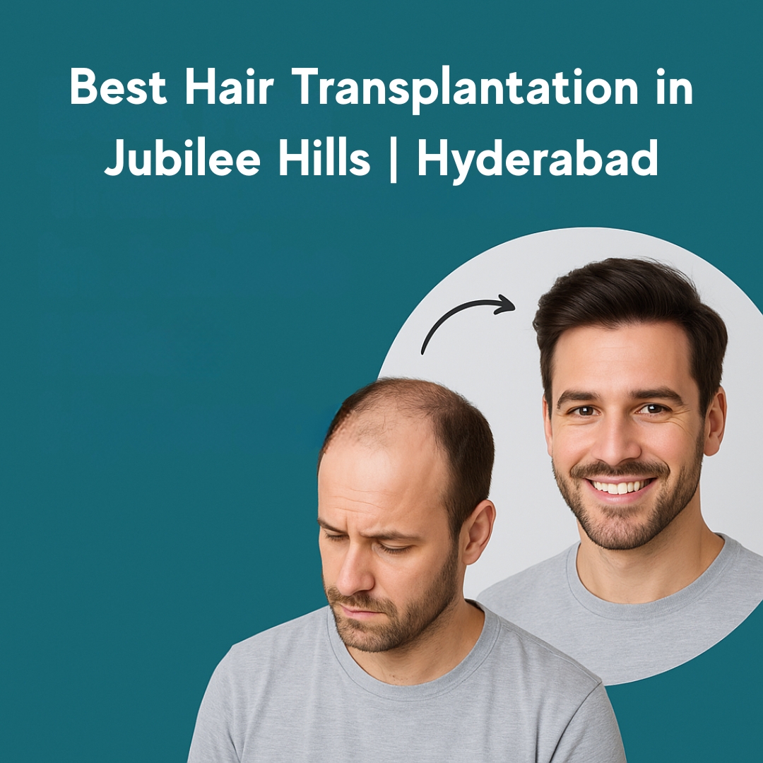 Best Hair Transplantation in Jubilee Hills | Hyderabad