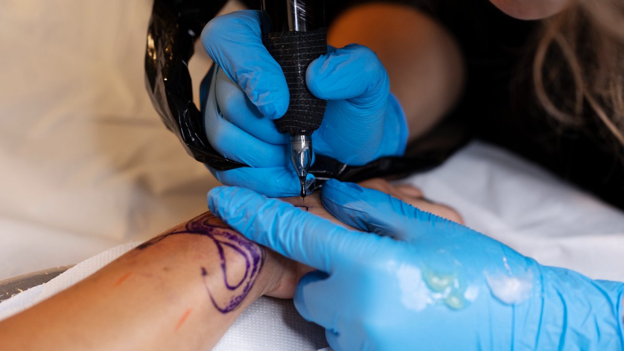 Laser Tattoo Removal