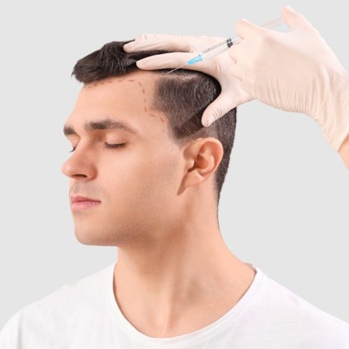 Hair Transplantation in Hyderabad