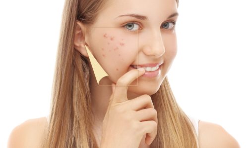 Dark Spot Remover for Face in Hyderabad